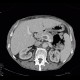 Trombosis of portal vein: CT - Computed tomography