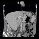 Trombosis of portal vein: CT - Computed tomography