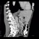 Trombosis of portal vein: CT - Computed tomography