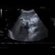 Trombosis of portal vein: US - Ultrasound