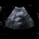 Trombosis of portal vein: US - Ultrasound