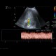 Trombosis of portal vein: US - Ultrasound