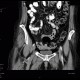 Thrombosis of femoral vein: CT - Computed tomography