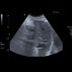 Tumorous thrombosis of inferior vena cava, adrenal metastasis, conventional renal carcinoma: US - Ultrasound