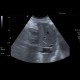 Tumorous thrombosis of inferior vena cava, adrenal metastasis, conventional renal carcinoma: US - Ultrasound