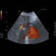 Tumorous thrombosis of inferior vena cava, adrenal metastasis, conventional renal carcinoma: US - Ultrasound