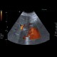 Tumorous thrombosis of inferior vena cava, adrenal metastasis, conventional renal carcinoma: US - Ultrasound