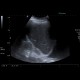 Tumorous thrombosis of inferior vena cava, adrenal metastasis, conventional renal carcinoma: US - Ultrasound