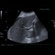 Tumorous thrombosis of inferior vena cava, adrenal metastasis, conventional renal carcinoma: US - Ultrasound