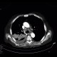Pulmonary tuberculosis, TBC, tuberculosis: CT - Computed tomography