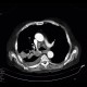 Pulmonary tuberculosis, TBC, tuberculosis: CT - Computed tomography