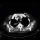 Pulmonary tuberculosis, TBC, tuberculosis: CT - Computed tomography