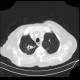 Pulmonary tuberculosis, TBC, tuberculosis: CT - Computed tomography