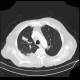 Pulmonary tuberculosis, TBC, tuberculosis: CT - Computed tomography