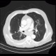 Pulmonary tuberculosis, TBC, tuberculosis: CT - Computed tomography