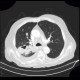 Pulmonary tuberculosis, TBC, tuberculosis: CT - Computed tomography
