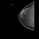 Fibroglandular type of breast, Tabar I: X-ray - Plain radiograph