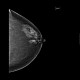 Fibroglandular type of breast, Tabar I: X-ray - Plain radiograph