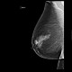 Fibroglandular type of breast, Tabar I: X-ray - Plain radiograph