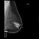 Fibroglandular type of breast, Tabar I: X-ray - Plain radiograph