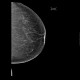 Mammography, normal finding, fatty type, Tabar II: MMG - Mammography
