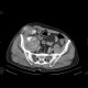 Tumour of cecum, extensive: CT - Computed tomography