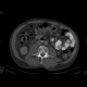 Tumour of cecum, extensive: CT - Computed tomography