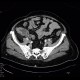Tumor of cecum, enterography: CT - Computed tomography