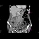 Tumour of cecum: CT - Computed tomography