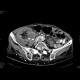 Tumour of cecum: CT - Computed tomography