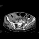 Tumour of cecum: CT - Computed tomography