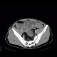Colorectal cancer, carcinoma of descendens, ileus: CT - Computed tomography