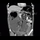 Colorectal cancer, carcinoma of descendens, ileus: CT - Computed tomography