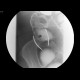 Sigmoid carcinoma, polyp of the ascending colon: RF - Fluoroscopy