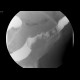 Sigmoid carcinoma, polyp of the ascending colon: RF - Fluoroscopy