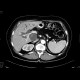 Tumour of the head of pancreas, dilated bile duct, biliary stent, dilated pancreatic duct, cholecystolithiasis, biliary stones: CT - Computed tomography