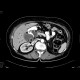 Tumour of the head of pancreas, dilated bile duct, biliary stent, dilated pancreatic duct, cholecystolithiasis, biliary stones: CT - Computed tomography