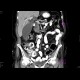 Tumour of the head of pancreas, dilated bile duct, biliary stent, dilated pancreatic duct, cholecystolithiasis, biliary stones: CT - Computed tomography