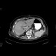 Tumour of the head of pancreas, dilated bile duct, biliary stent, dilated pancreatic duct, cholecystolithiasis, biliary stones: CT - Computed tomography