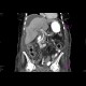 Tumour of the head of pancreas, dilated bile duct, biliary stent, dilated pancreatic duct, cholecystolithiasis, biliary stones: CT - Computed tomography