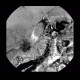 Hypervascular tumour of pancreatic head: AG - Angiography