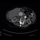 Hypervascular tumour of pancreatic head, hemangioma of vertebral body: CT - Computed tomography