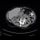 Hypervascular tumour of pancreatic head, hemangioma of vertebral body: CT - Computed tomography