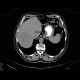 Hepatocellular adenoma, bleeding after biopsy: CT - Computed tomography