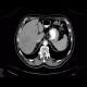 Hepatocellular adenoma, bleeding after biopsy: CT - Computed tomography