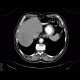 Hepatocellular adenoma, bleeding after biopsy: CT - Computed tomography