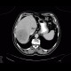 Hepatocellular adenoma, bleeding after biopsy: CT - Computed tomography