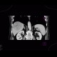 Hepatocellular adenoma, bleeding after biopsy: CT - Computed tomography