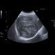 Hepatocellular adenoma, bleeding after biopsy: US - Ultrasound