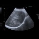 Hepatocellular adenoma, bleeding after biopsy: US - Ultrasound